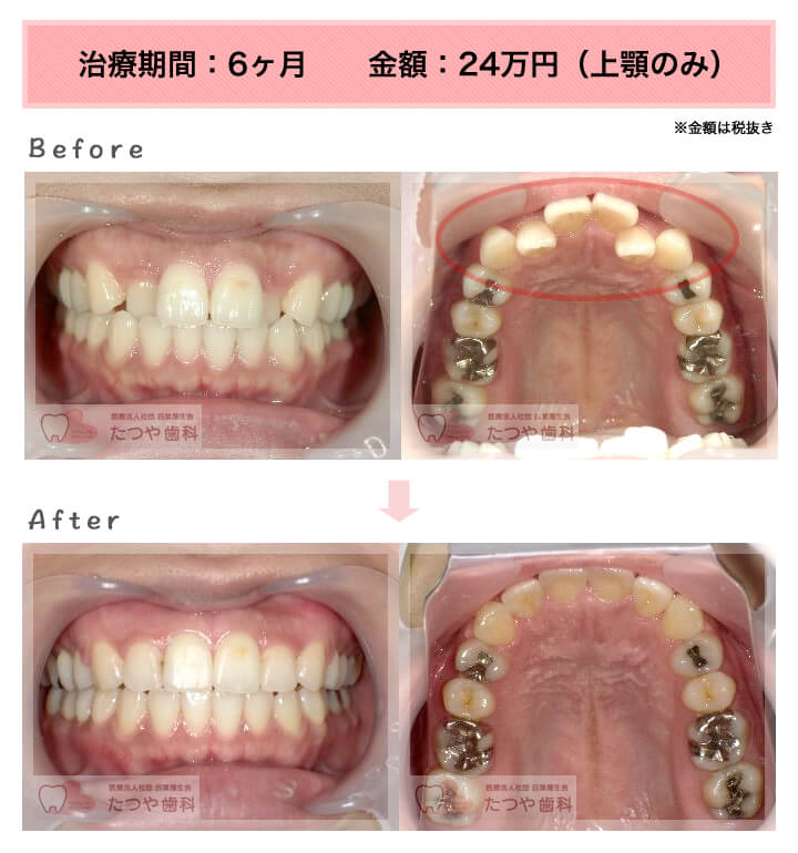 部分矯正の症例　八重歯