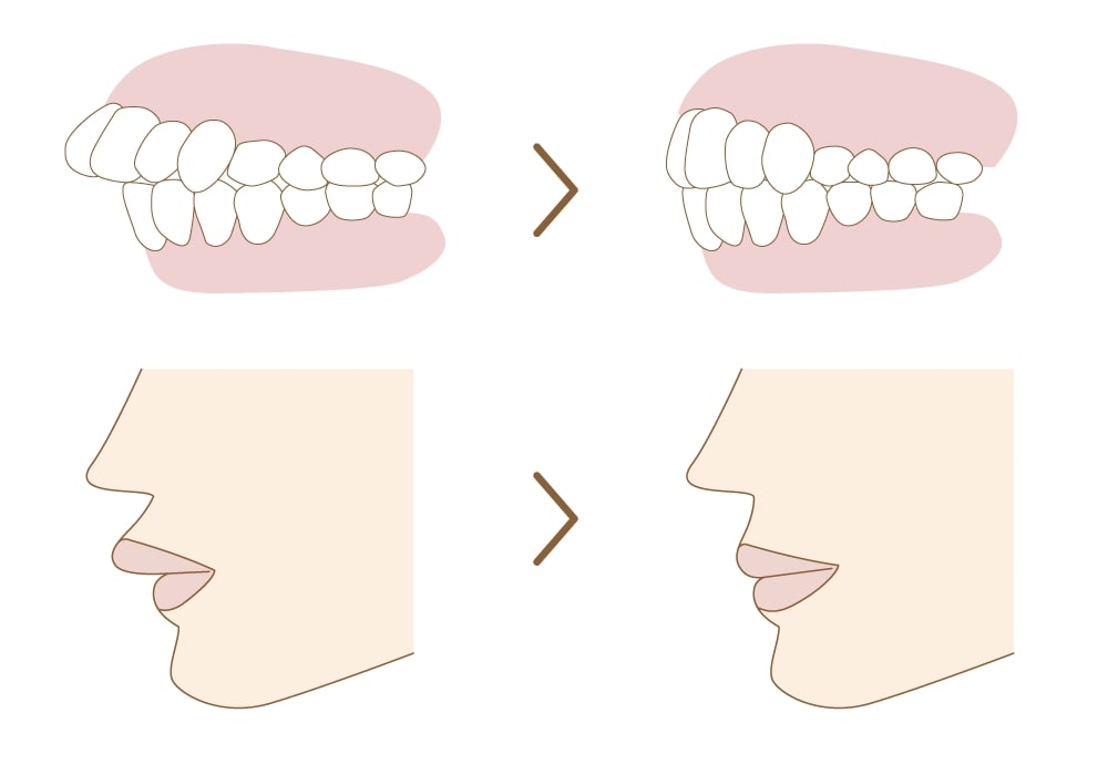 前歯の「出っ歯」と矯正治療