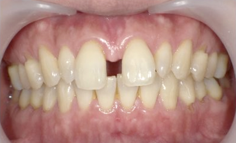 すきっ歯を部分矯正で治した症例