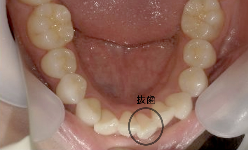 部分矯正 20代の症例写真