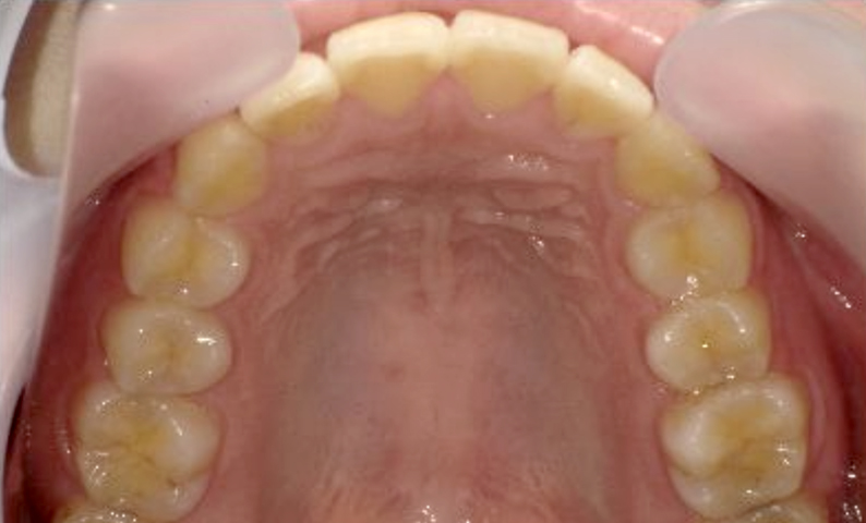 部分矯正 20代の症例写真