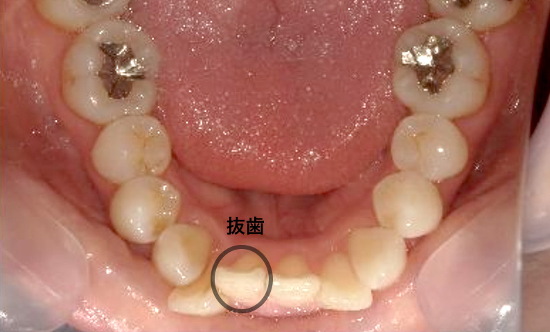 部分矯正 20代の症例写真