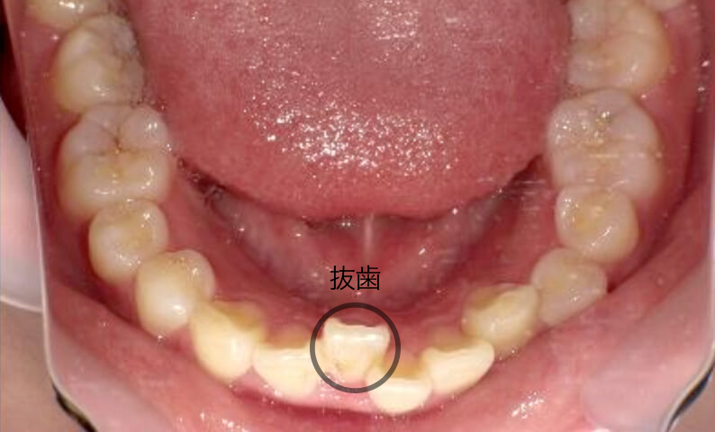 部分矯正 20代の症例写真