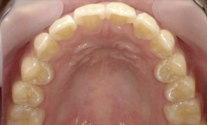 部分矯正 20代の症例写真