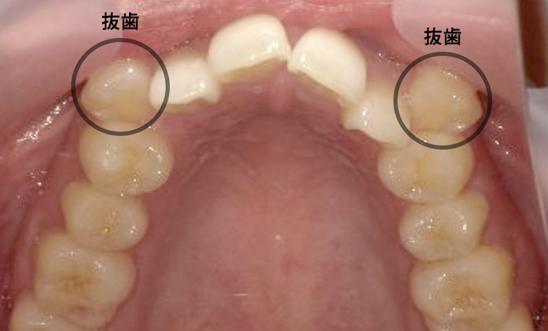 部分矯正 20代の症例写真