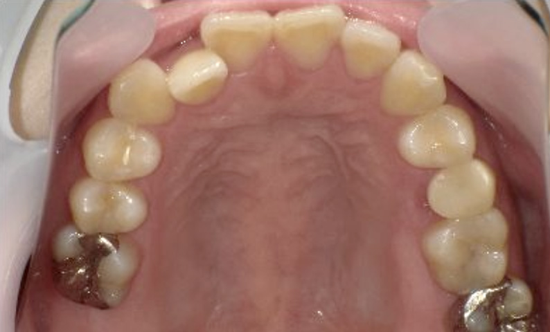 部分矯正 20代の症例写真