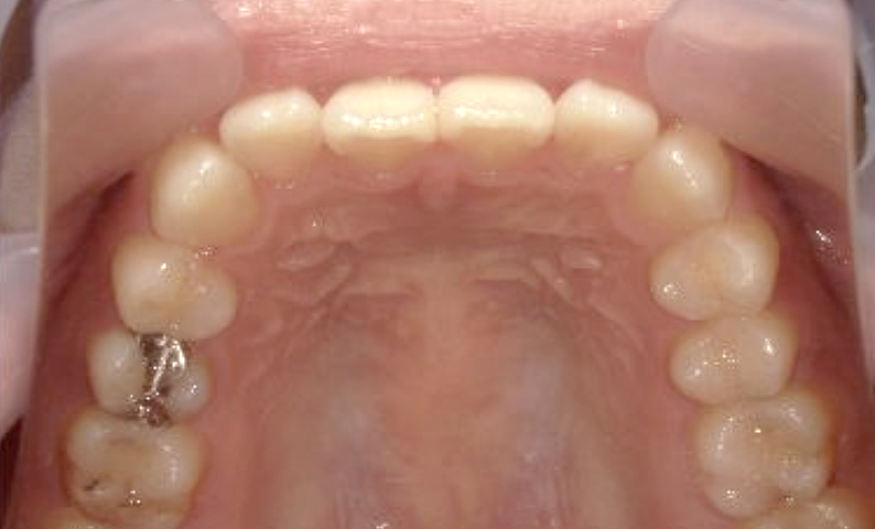 部分矯正 20代の症例写真
