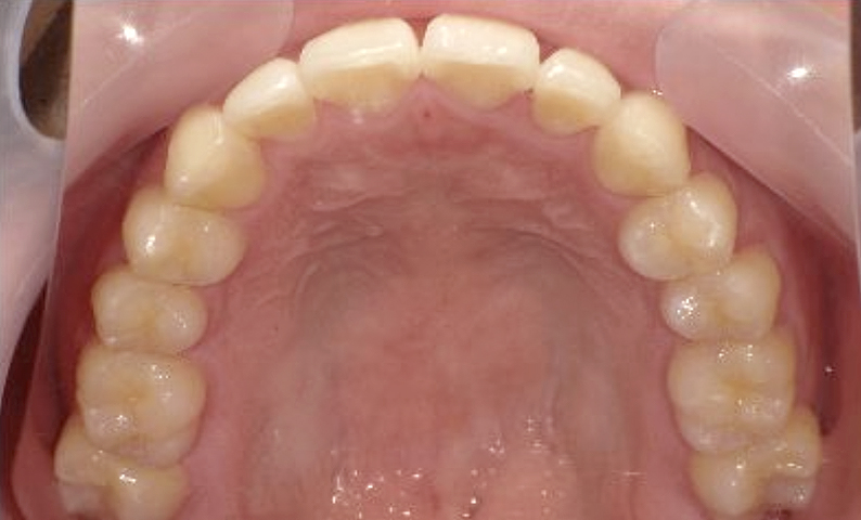部分矯正 20代の症例写真