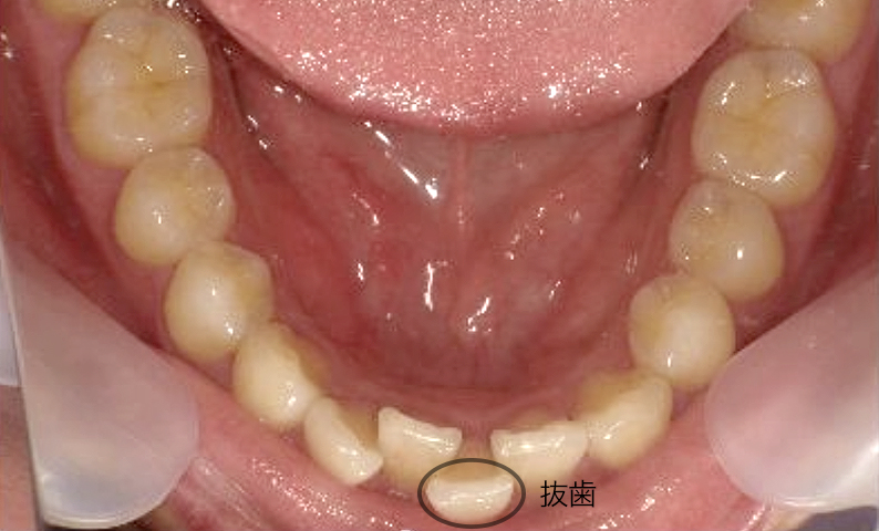 部分矯正 20代の症例写真