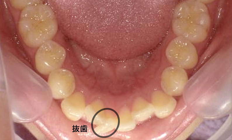 部分矯正 20代の症例写真