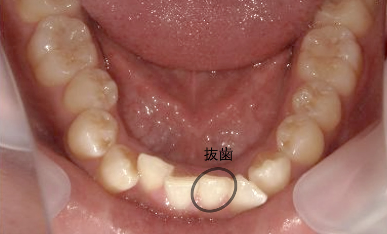 部分矯正 20代の症例写真