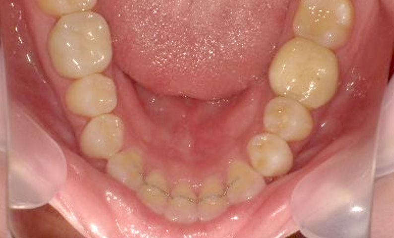 出っ歯を部分矯正で治した症例