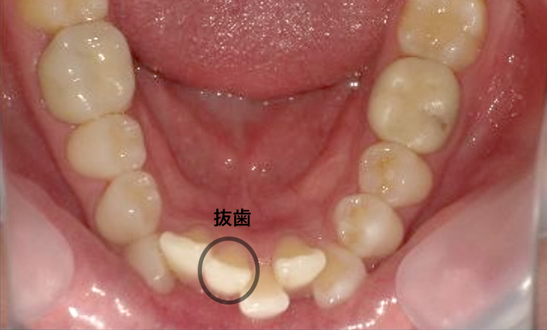 部分矯正 20代の症例写真