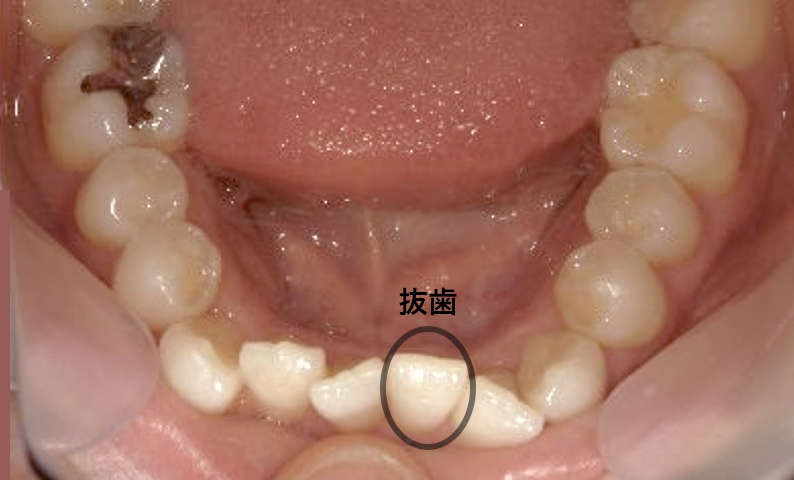 部分矯正 20代の症例写真