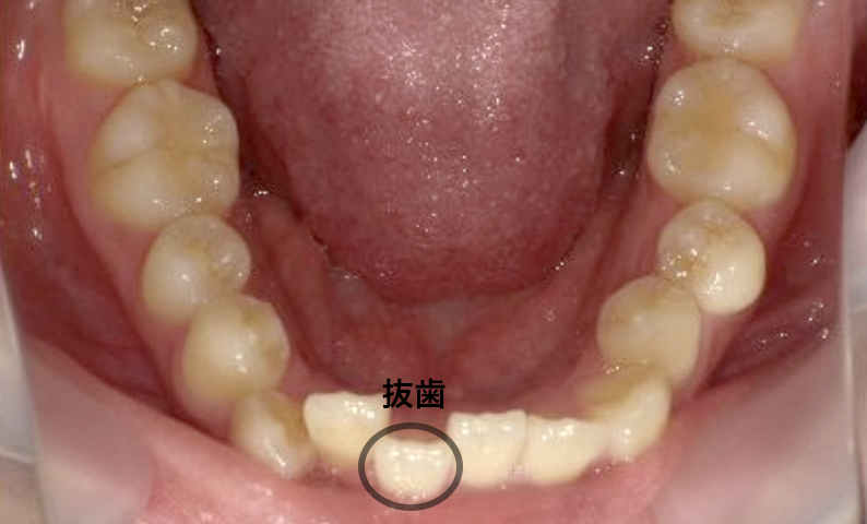 部分矯正 20代の症例写真