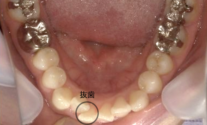 部分矯正 30代の症例写真