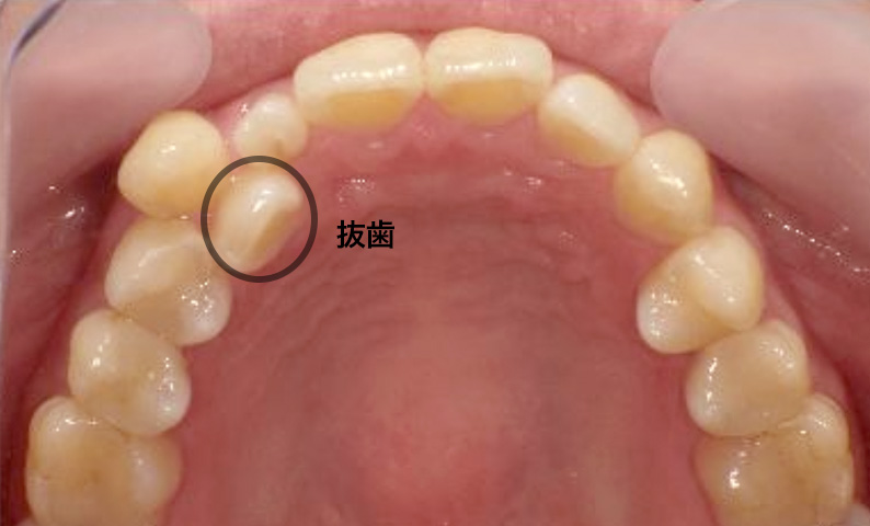 部分矯正 30代の症例写真