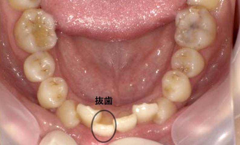 部分矯正 30代の症例写真