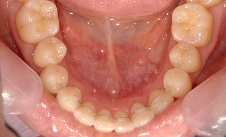部分矯正 30代の症例写真