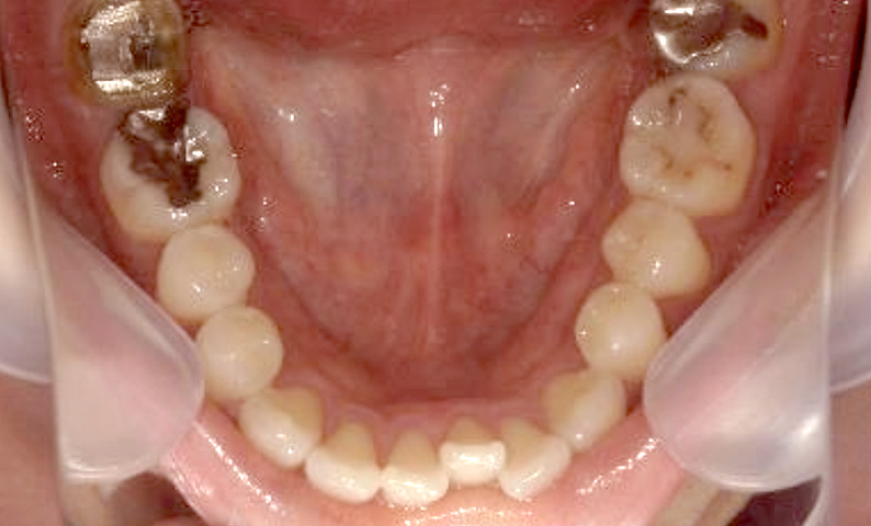 部分矯正 30代の症例写真