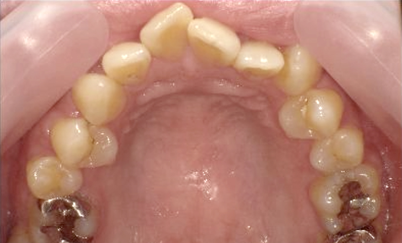 部分矯正 30代の症例写真
