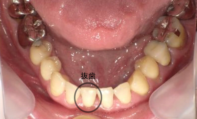 部分矯正 40代の症例写真