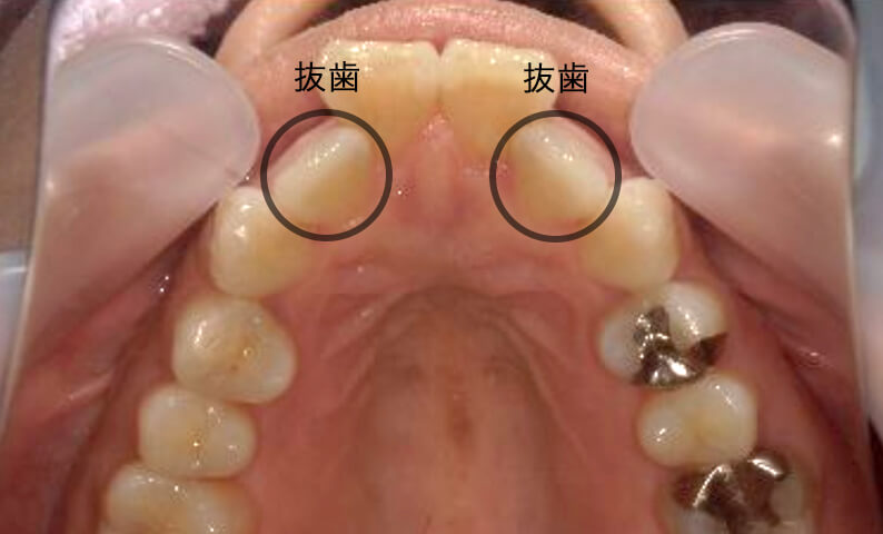部分矯正 40代の症例写真