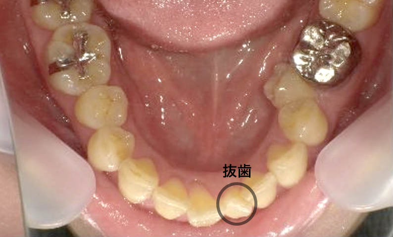 部分矯正 40代の症例写真
