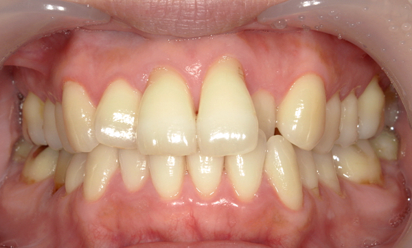 部分矯正 40代の症例写真