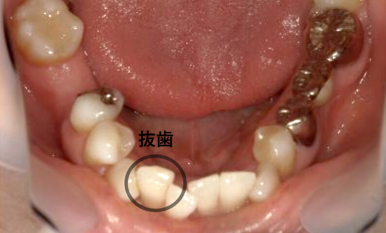 部分矯正 50代の症例写真