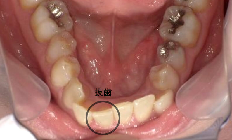 部分矯正 50代の症例写真