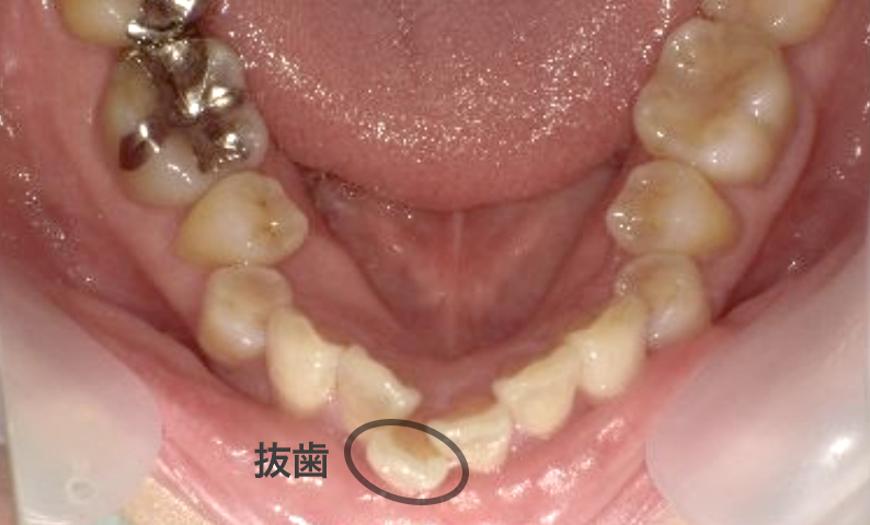 部分矯正 50代の症例写真