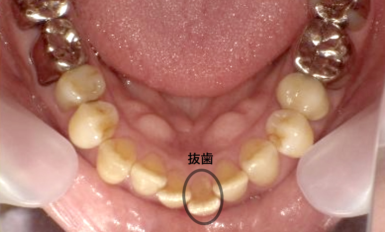 部分矯正 50代の症例写真