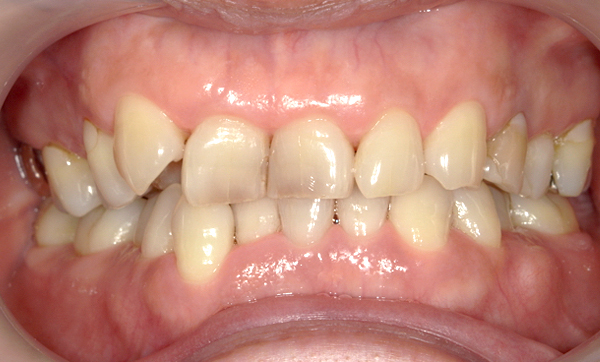 部分矯正 50代の症例写真