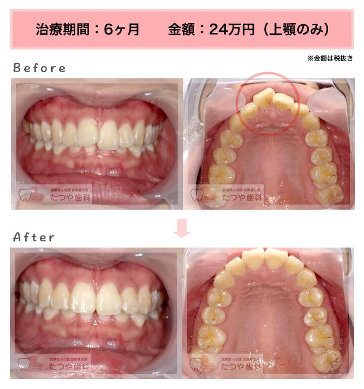 部分矯正の症例 前歯「少しのねじれ」
