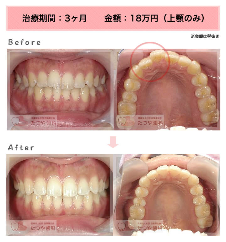 部分矯正の症例 前歯「少しのねじれ」