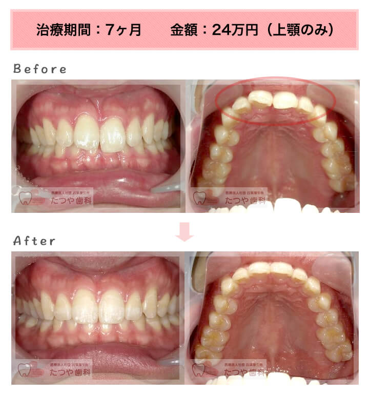部分矯正の症例 前歯「少しのねじれ」