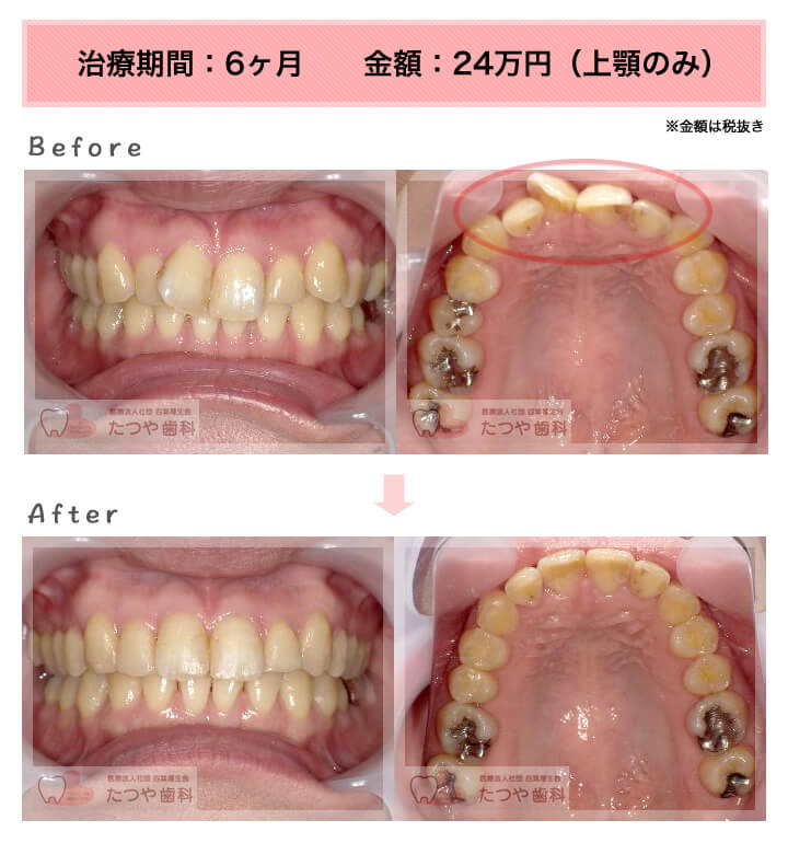 部分矯正の症例 前歯「少しのねじれ」