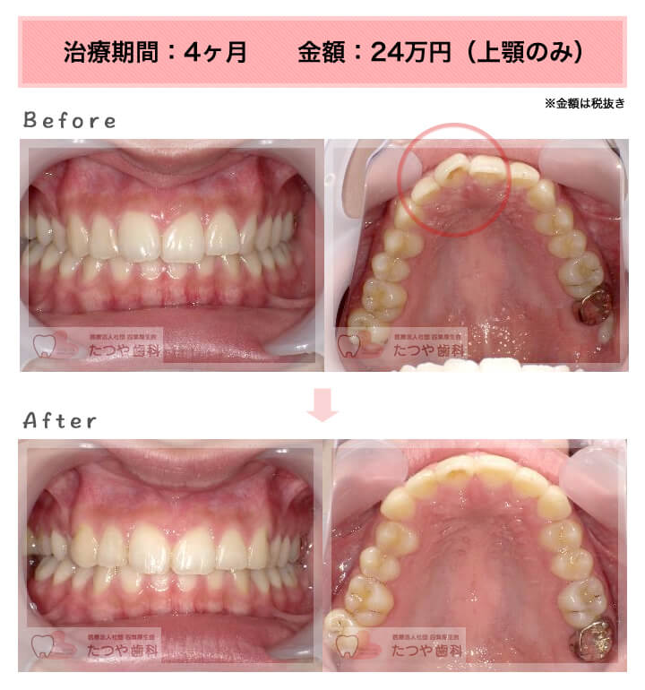 部分矯正の症例 前歯「少しのねじれ」
