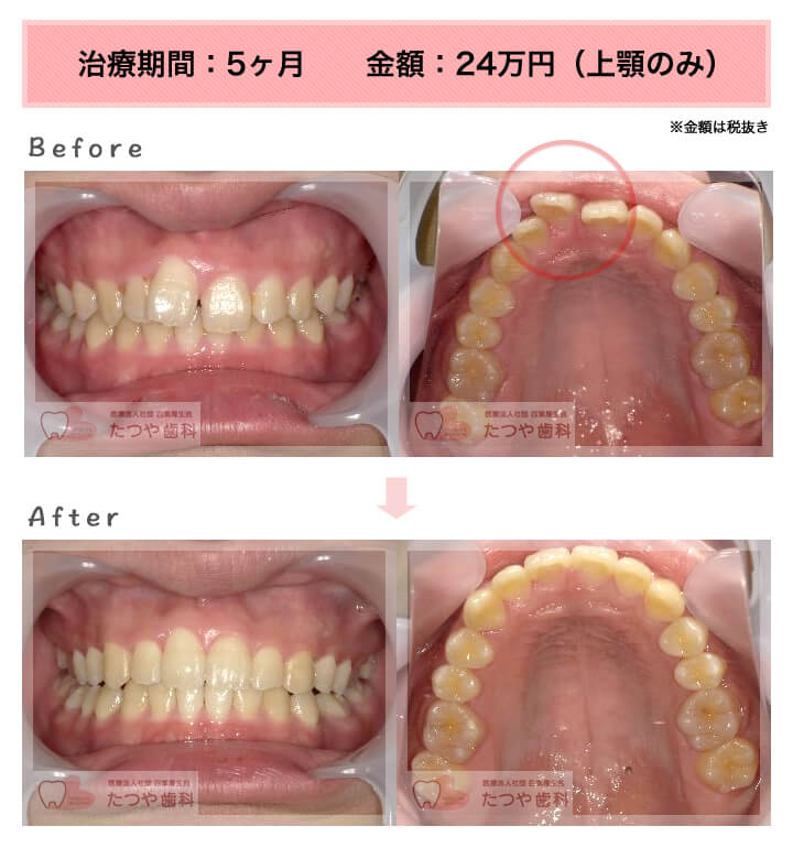 部分矯正の症例　前歯「少しのねじれ」