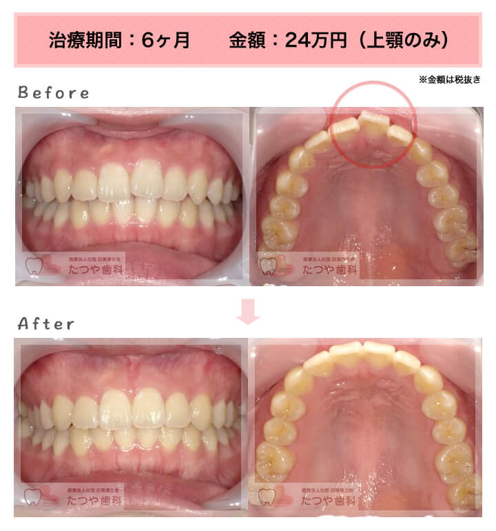 部分矯正の症例 前歯「少しのねじれ」