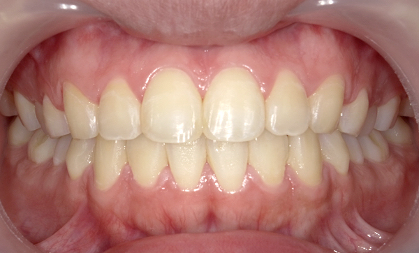 前歯のねじれ「捻転歯」部分矯正の症例集