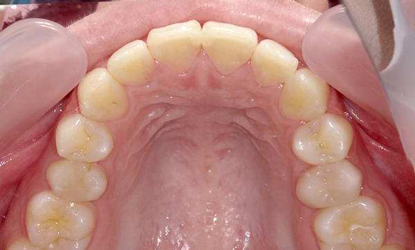 前歯のねじれ「捻転歯」部分矯正の症例集