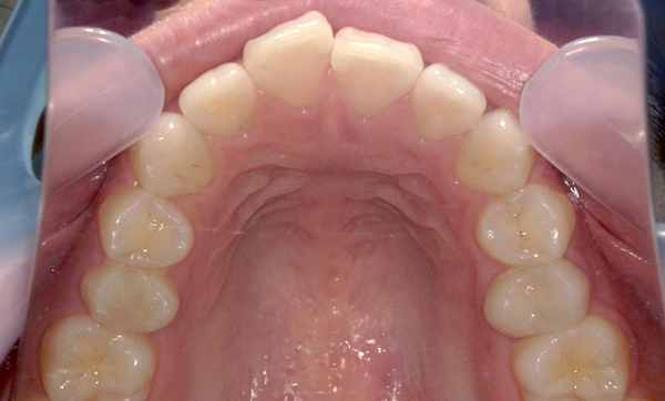 前歯のねじれ「捻転歯」部分矯正の症例集