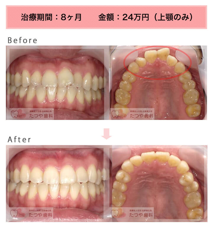 部分矯正の症例　出っ歯