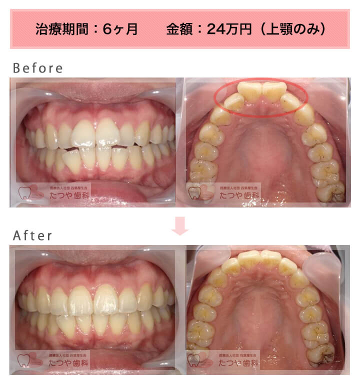 部分矯正の症例　出っ歯