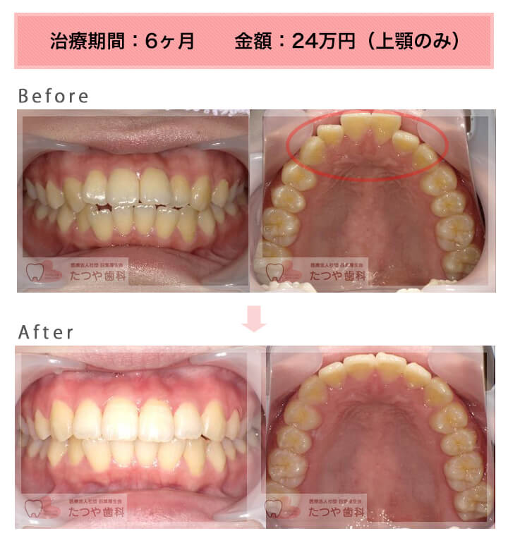 部分矯正の症例　出っ歯