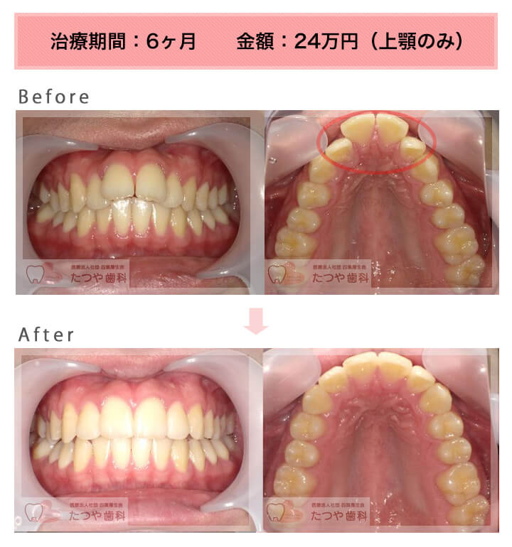 部分矯正の症例　出っ歯