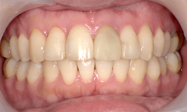 部分矯正 上の部分矯正の症例写真