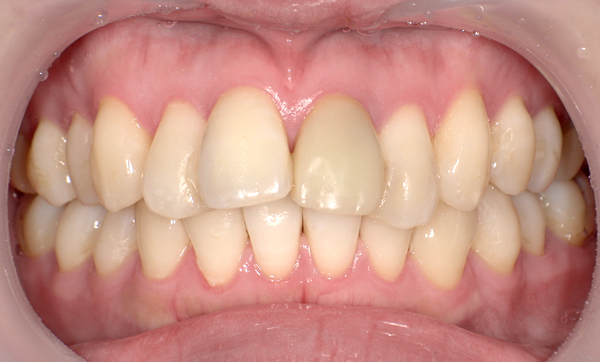 部分矯正 上の部分矯正の症例写真